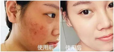 皮肤科医生力荐 医用面膜如何一招摆脱敏感肌困扰？